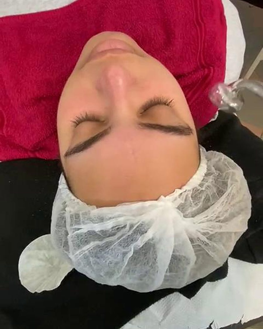 Peeling Químico y Enzimático en Skin Beauty